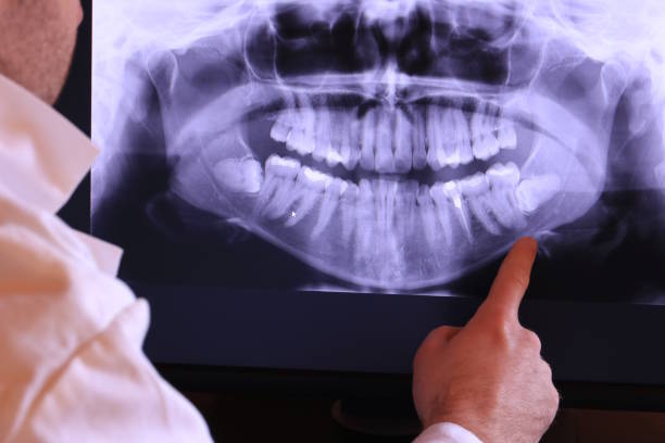 Best Emergency Wisdom Teeth Removal in Moncks Corner, SC