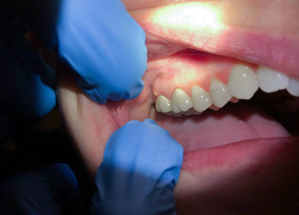 Best Emergency Tooth Extraction in Moncks Corner, SC